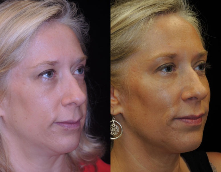 Voluma before and after photo by Kristin J Tarbet MD in Bellevue WA