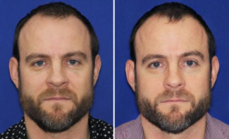 Belotero Under Eyes before and after photo by Kristin J Tarbet MD in Bellevue WA