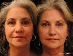 Belotero tear troughs before and after photo by Kristin J Tarbet MD in Bellevue WA