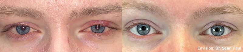 Dry Eye before and after photo by Kristin J Tarbet MD in Bellevue WA