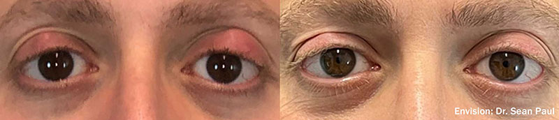Dry Eye before and after photo by Kristin J Tarbet MD in Bellevue WA