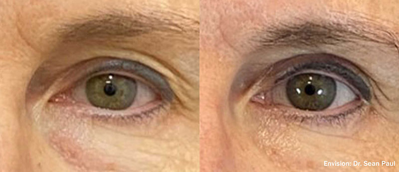 Dry Eye before and after photo by Kristin J Tarbet MD in Bellevue WA