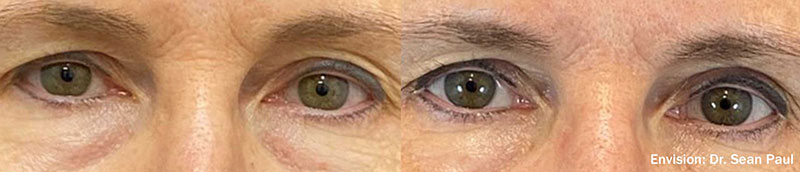 Dry Eye before and after photo by Kristin J Tarbet MD in Bellevue WA