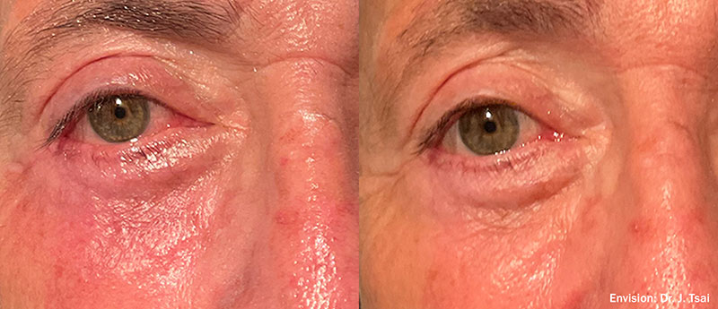 Forma Red Eyes before and after photo by Kristin J Tarbet MD in Bellevue WA