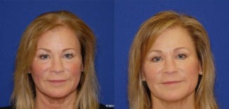 Hair Restoration before and after photo by Kristin J Tarbet MD in Bellevue WA
