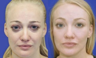 Juvederm and Voluma before and after photo by Kristin J Tarbet MD in Bellevue WA