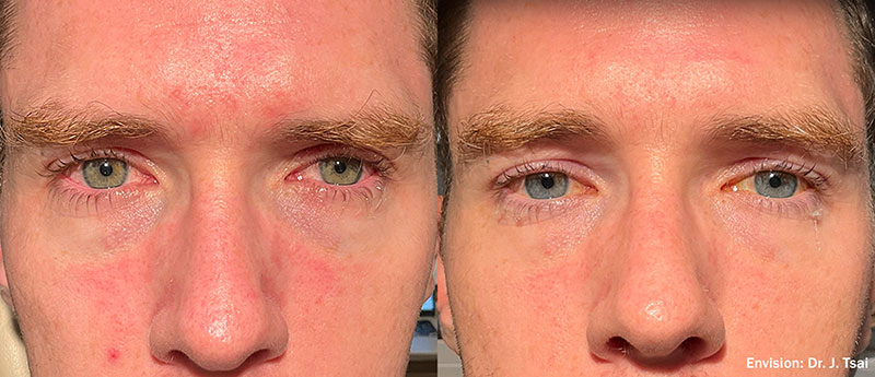 Lumecca Forma Cheeks before and after photo by Kristin J Tarbet MD in Bellevue WA