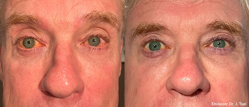 Lumecca Forma Cheeks before and after photo by Kristin J Tarbet MD in Bellevue WA