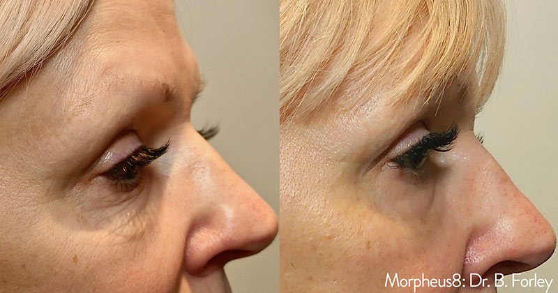 Morpheus before and after photo by Kristin J Tarbet MD in Bellevue WA