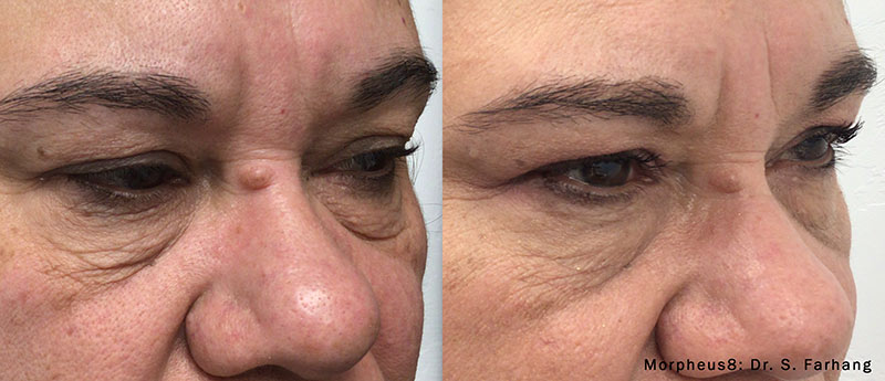 Morpheus before and after photo by Kristin J Tarbet MD in Bellevue WA