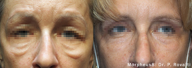 Morpheus before and after photo by Kristin J Tarbet MD in Bellevue WA
