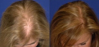 PRP Hair before and after photo by Kristin J Tarbet MD in Bellevue WA