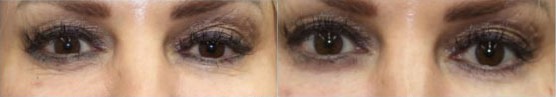 PRP Injections under eyes before and after photo by Kristin J Tarbet MD in Bellevue WA