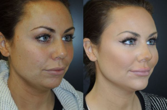 Radiesse chin and cheeks before and after photo by Kristin J Tarbet MD in Bellevue WA
