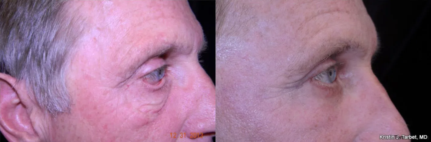 Lower Lid Blepharoplasty, Ectropion Repair with fat transfer before and after photo by Kristin J Tarbet MD in Bellevue WA