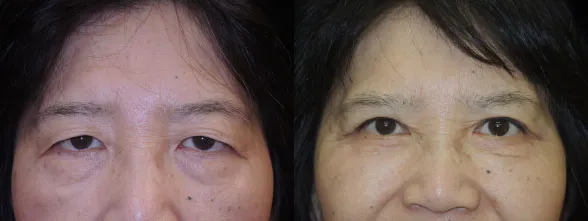 QUAD Bleph before and after photo by Kristin J Tarbet MD in Bellevue WA
