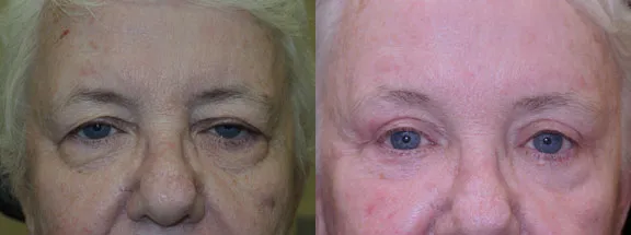QUAD Bleph:Endoscopic Browlift before and after photo by Kristin J Tarbet MD in Bellevue WA