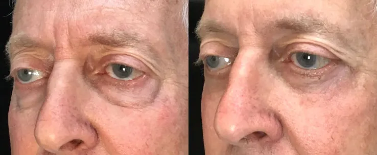 Transconjunctival Lower Bleph, Cheeklift, Ectropion repair before and after photo by Kristin J Tarbet MD in Bellevue WA