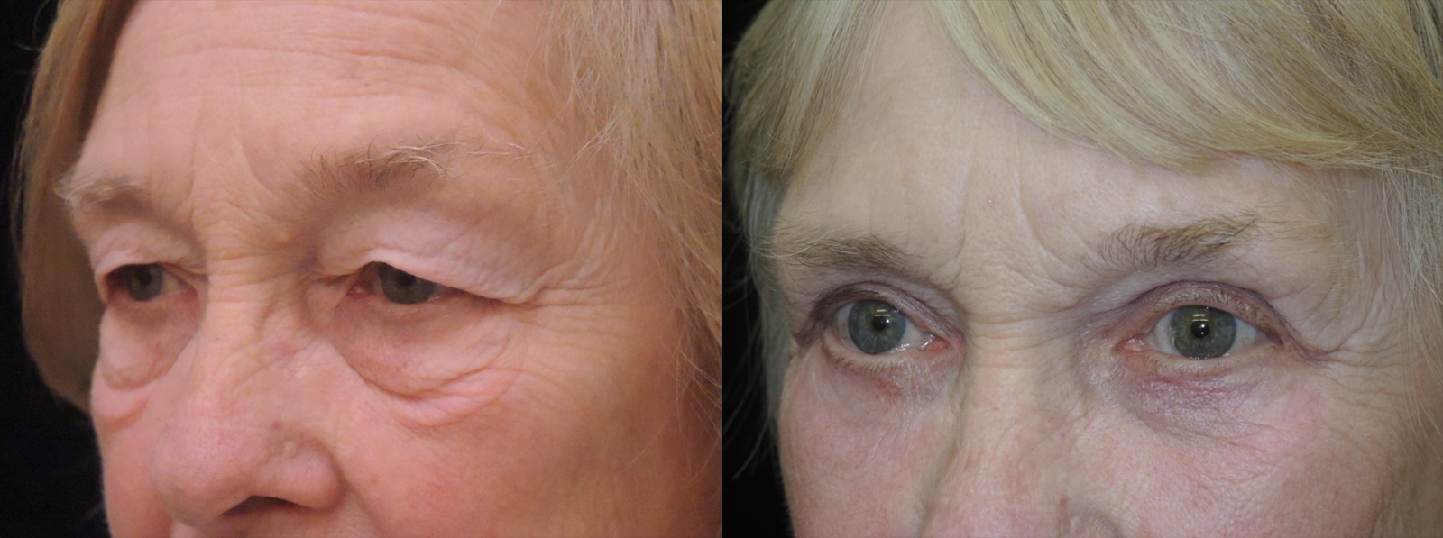 blepharoplasty droopy lids before and after photo by kristin j tarbet md in bellevue wa