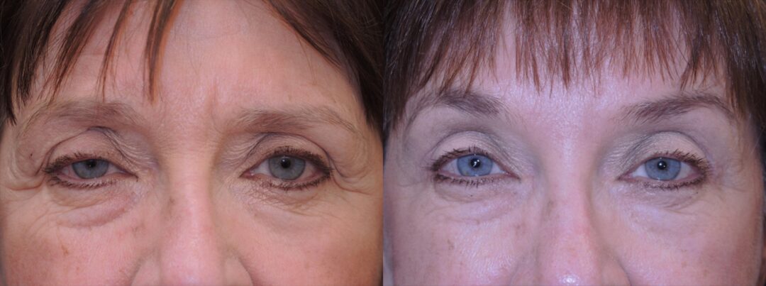 blepharoplasty droopy lids before and after photo by kristin j tarbet md in bellevue wa
