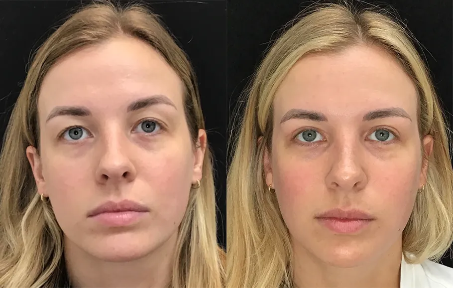 Front View Upper Blepharoplasty Results