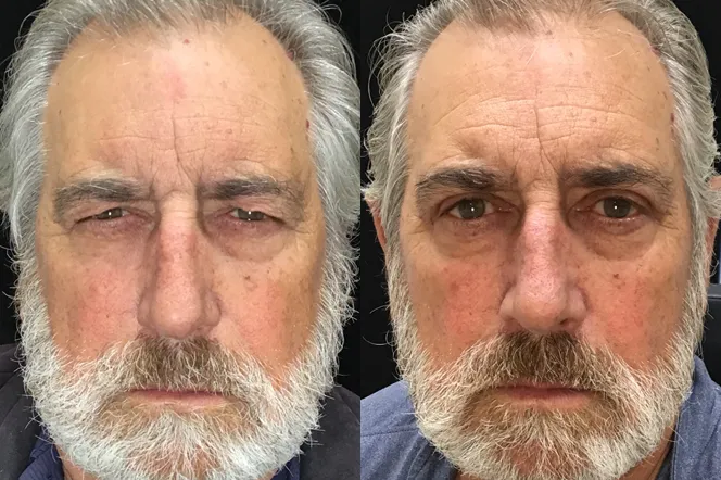 Front View Upper Bleph before and after photo by Kristin J Tarbet MD in Bellevue WA