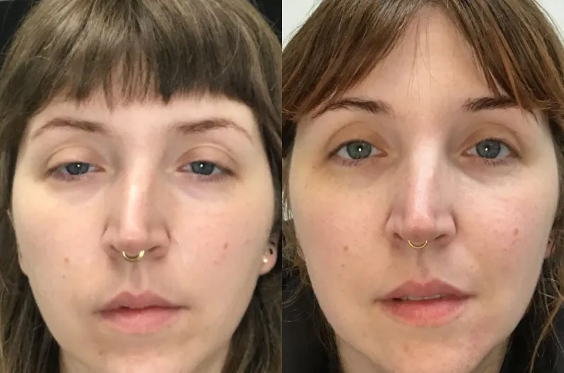 Ptosis Repair before and after photo by Kristin J Tarbet MD in Bellevue WA