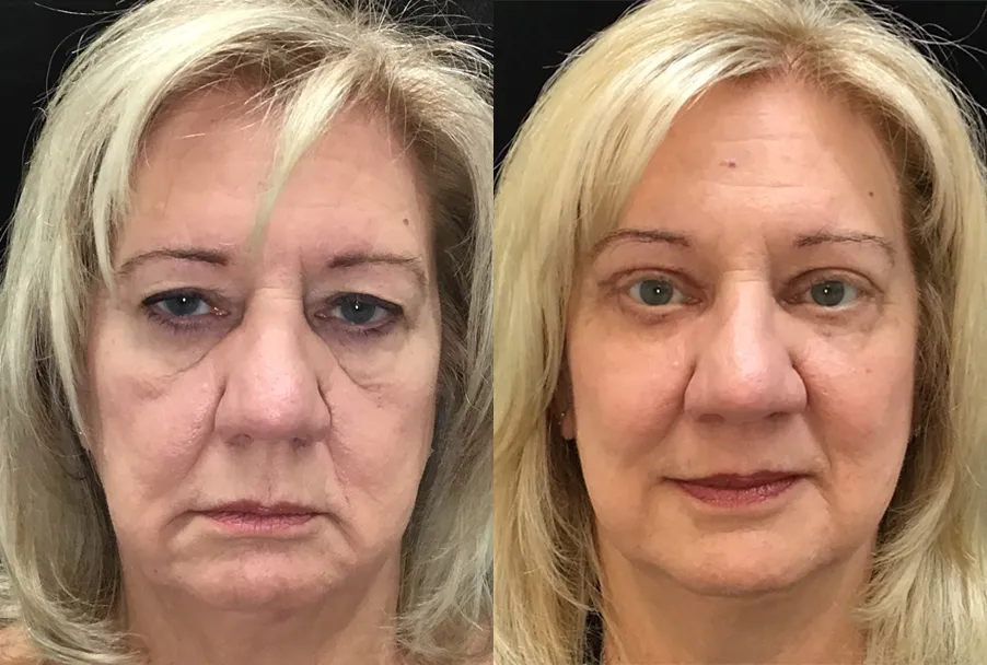 Quad Blepharoplasty, Ptosis Repair, Ectropion Repair, Endoscopic Browlift before and after photo by Kristin J Tarbet MD in Bellevue WA