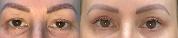 Upper Bleph with Ptosis Repair before and after photo by Kristin J Tarbet MD in Bellevue WA