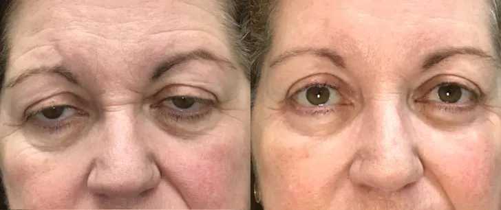 Upper Eyelid Ptosis:Lower Lid Ectropion before and after photo by Kristin J Tarbet MD in Bellevue WA