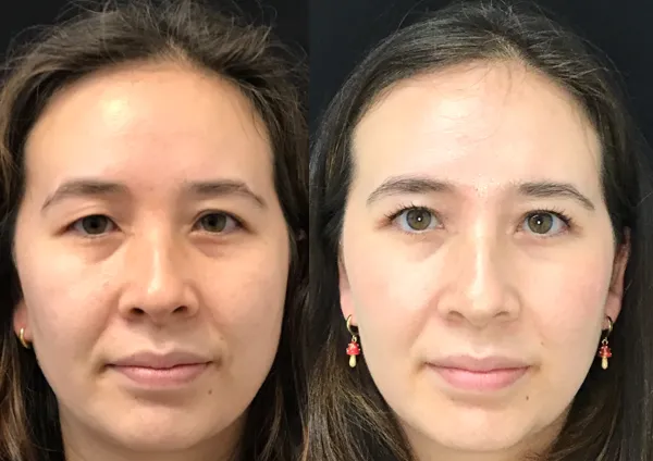 Upperlid Blepharoplasty with Novathread browlift before and after photo by Kristin J Tarbet MD in Bellevue WA