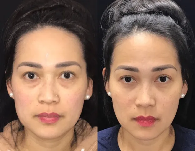 Front View Lower Blepharoplasty before and after photo by Kristin J Tarbet MD