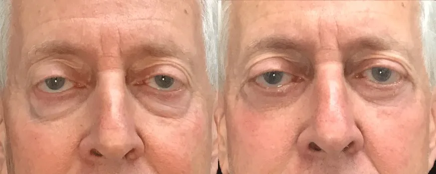 Lower Bleph, Canthopexy stitch, Cheeklift, reposition fat, ectropion repair before and after photo by Kristin J Tarbet MD