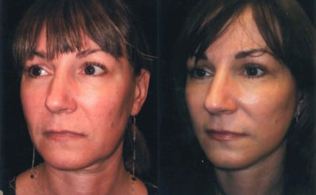 facelift before and after photo by kristin j tarbet md in bellevue wa