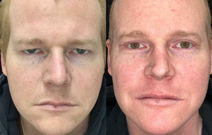 Bilateral Upper Bleph before and after photo by Kristin J Tarbet MD