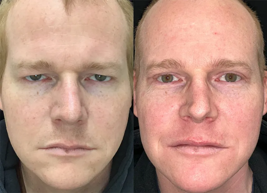 Bilateral Upper Bleph before and after photo by Kristin J Tarbet MD