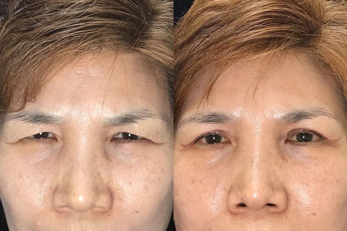 Bilateral upper lid blepharoplasty before and after photo by Kristin J Tarbet MD