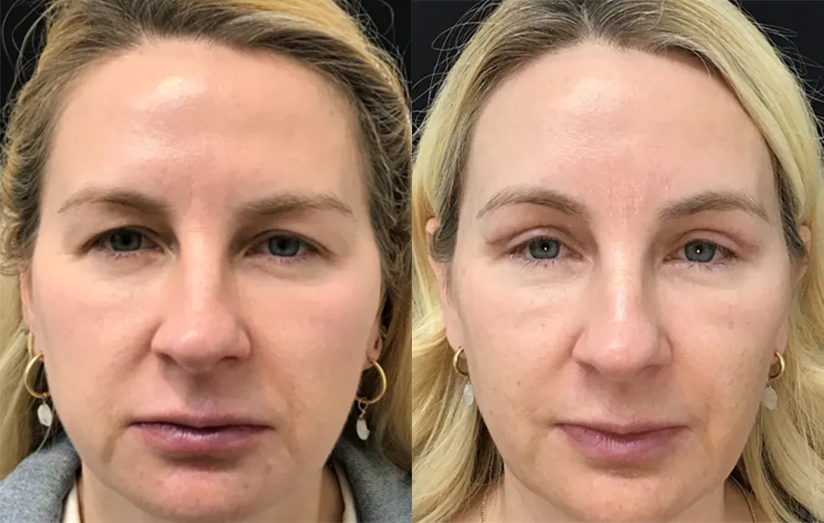 Endoscopic Browlift with Upper Bleph before and after photo by Kristin J Tarbet MD