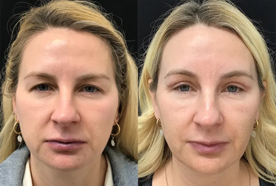 Endoscopic Browlift with Upper Bleph before and after photo by Kristin J Tarbet MD
