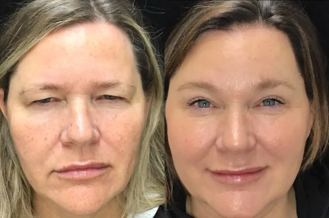 Front View BUL Blepharoplasty, Endobrow before and after photo by Dr. Tarbet