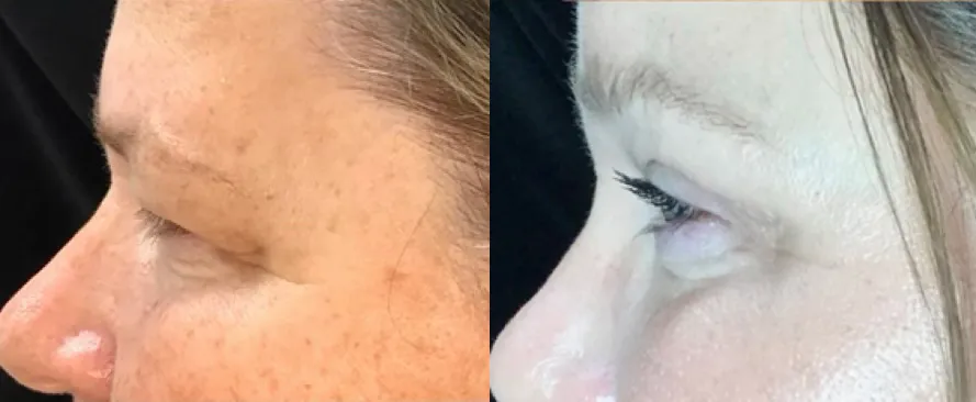 Left Side View BUL Blepharoplasty, Endobrow before and after photo by Dr. Tarbet