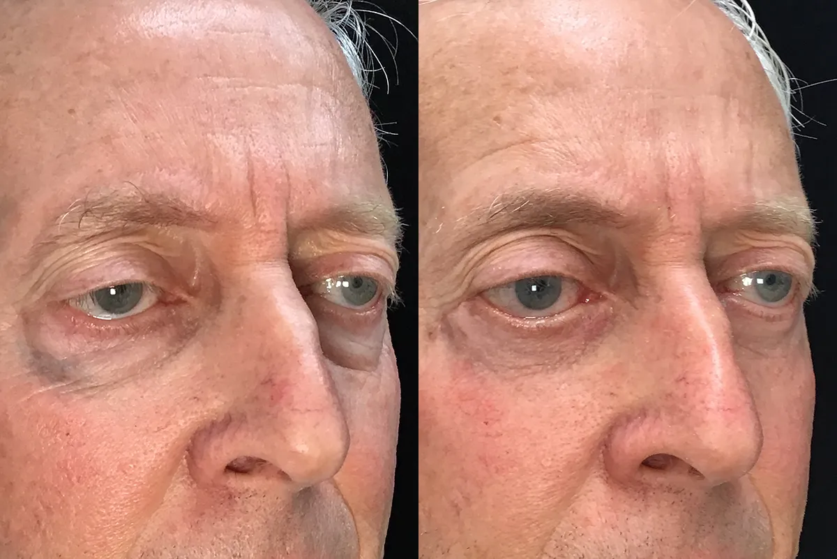 Lower Blepharoplasty, Canthopexy stitch, Cheeklift, reposition fat, ectropion repair before and after photo by Kristin J Tarbet MD