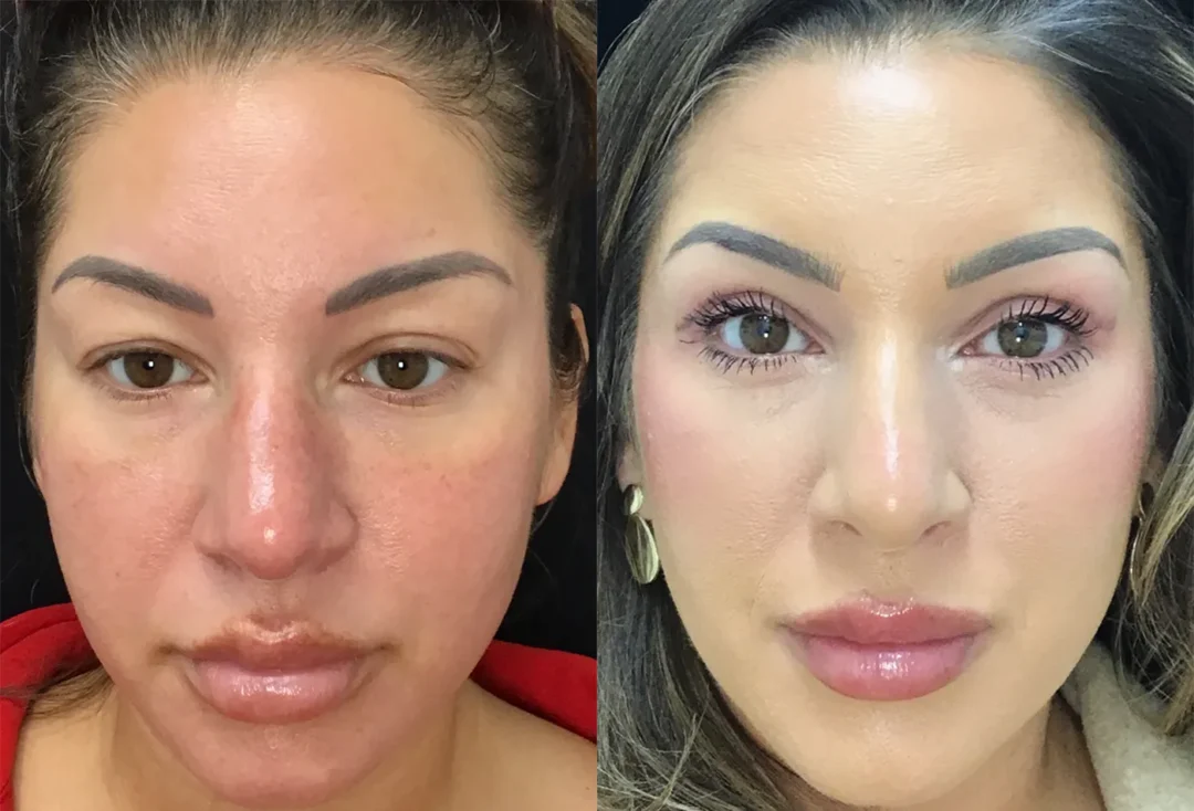 Upper Bleph before and after photo by Kristin J Tarbet MD