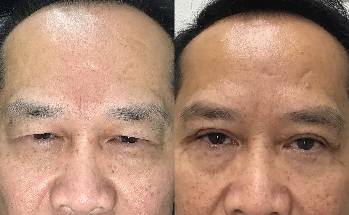 Upper and lower blepharoplasty before and after photo by Kristin J Tarbet MD