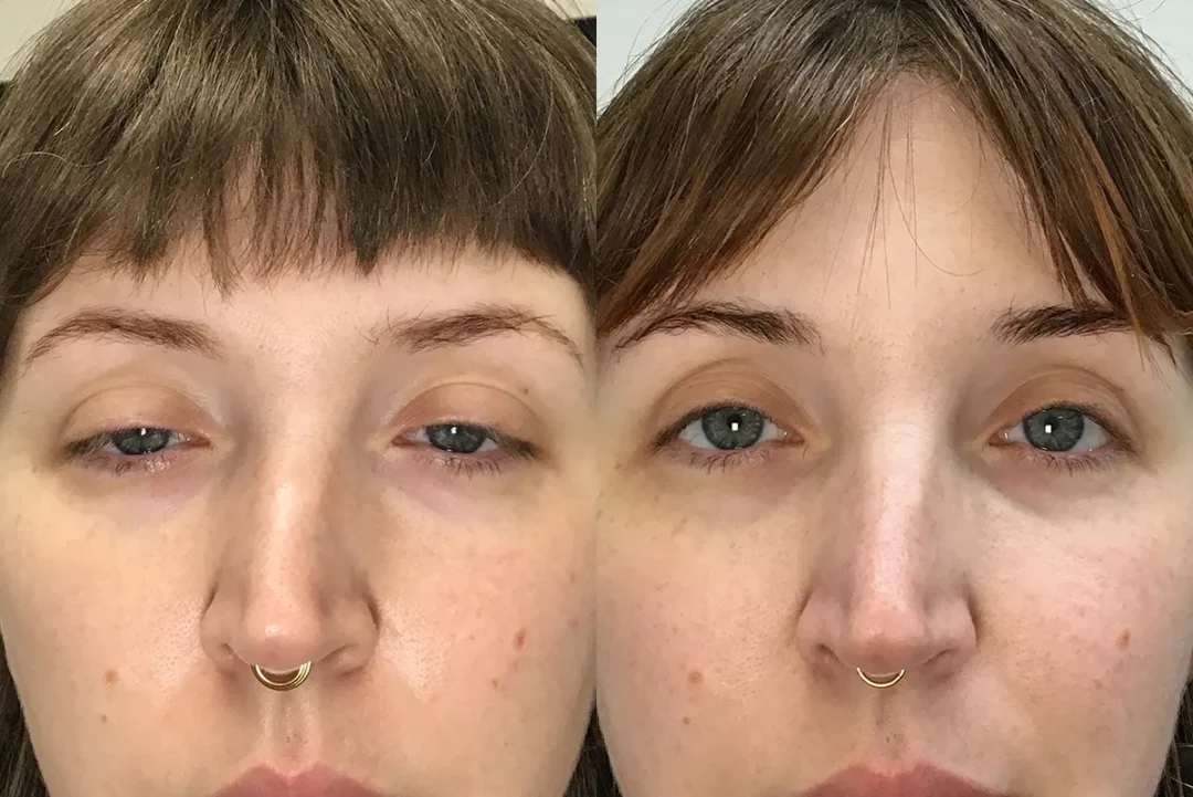 bilateral upper lid conjunctive mullerectomy before and after photo by Kristin J Tarbet MD