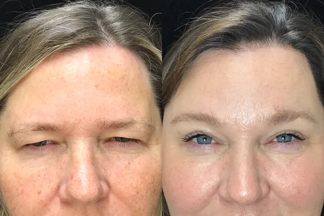 upper lid blepharoplasty and endoscopic browlift before and after photo by Kristin J Tarbet MD