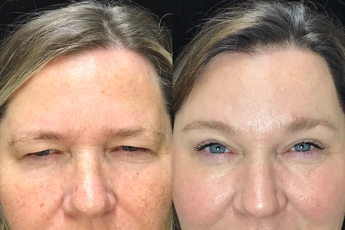 upper lid blepharoplasty and endoscopic browlift before and after photo by Kristin J Tarbet MD