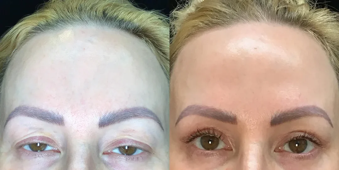 upper lid blepharoplasty and upper lid conjunctive mullerectomy before and after photo by Kristin J Tarbet MD