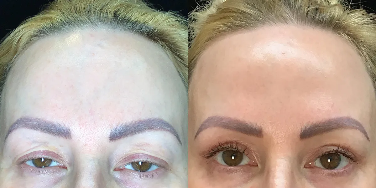 upper lid blepharoplasty and upper lid conjunctive mullerectomy before and after photo by Kristin J Tarbet MD
