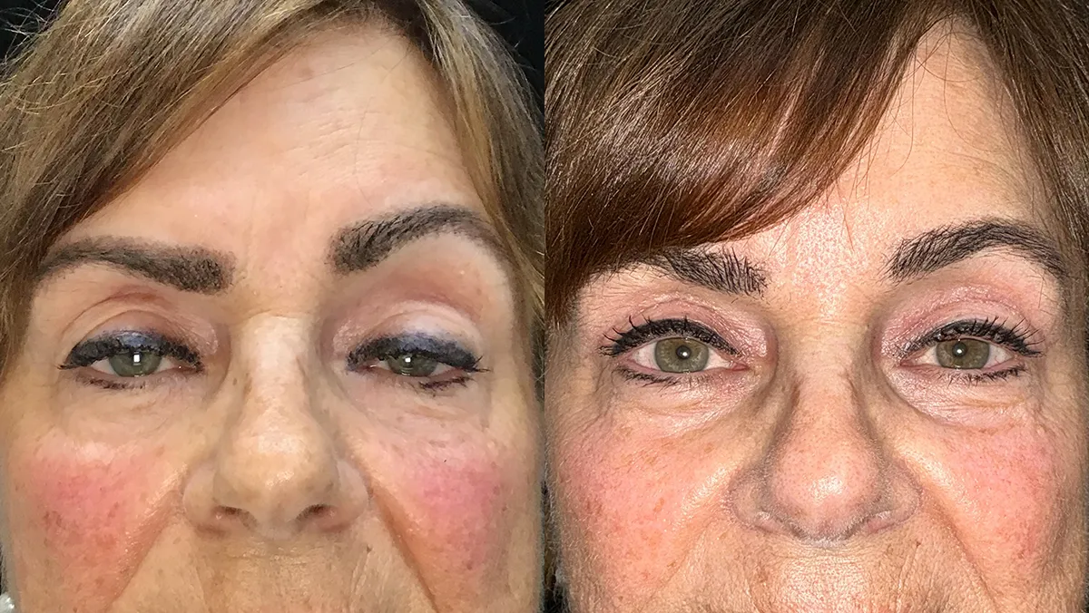 upper lid blepharoplasty & conjunctive mullerectomy before and after photo by Kristin J Tarbet MD